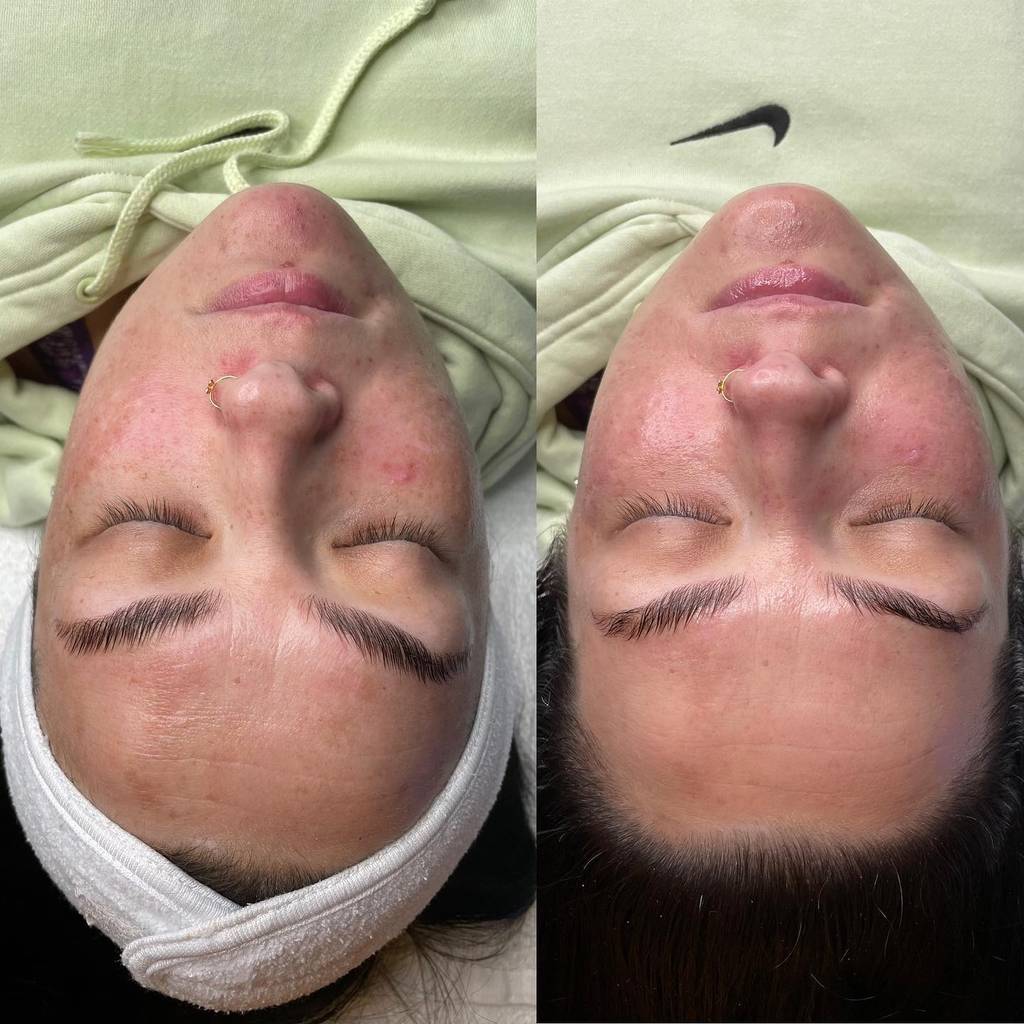 HydraFacial skin tightening treatment for elasticity and firmness at Saije Esthetics Beaverton Oregon