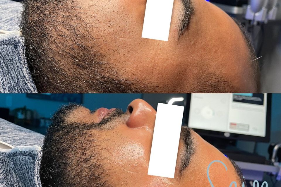 Not Just for the Ladies: The Rise of Facials for Men