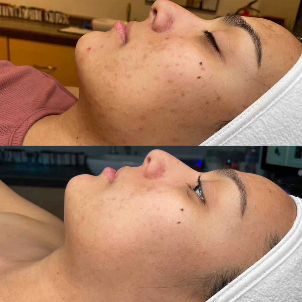 HydraFacial pigmentation treatment for hyperpigmentation correction and even skin tone Beaverton Oregon