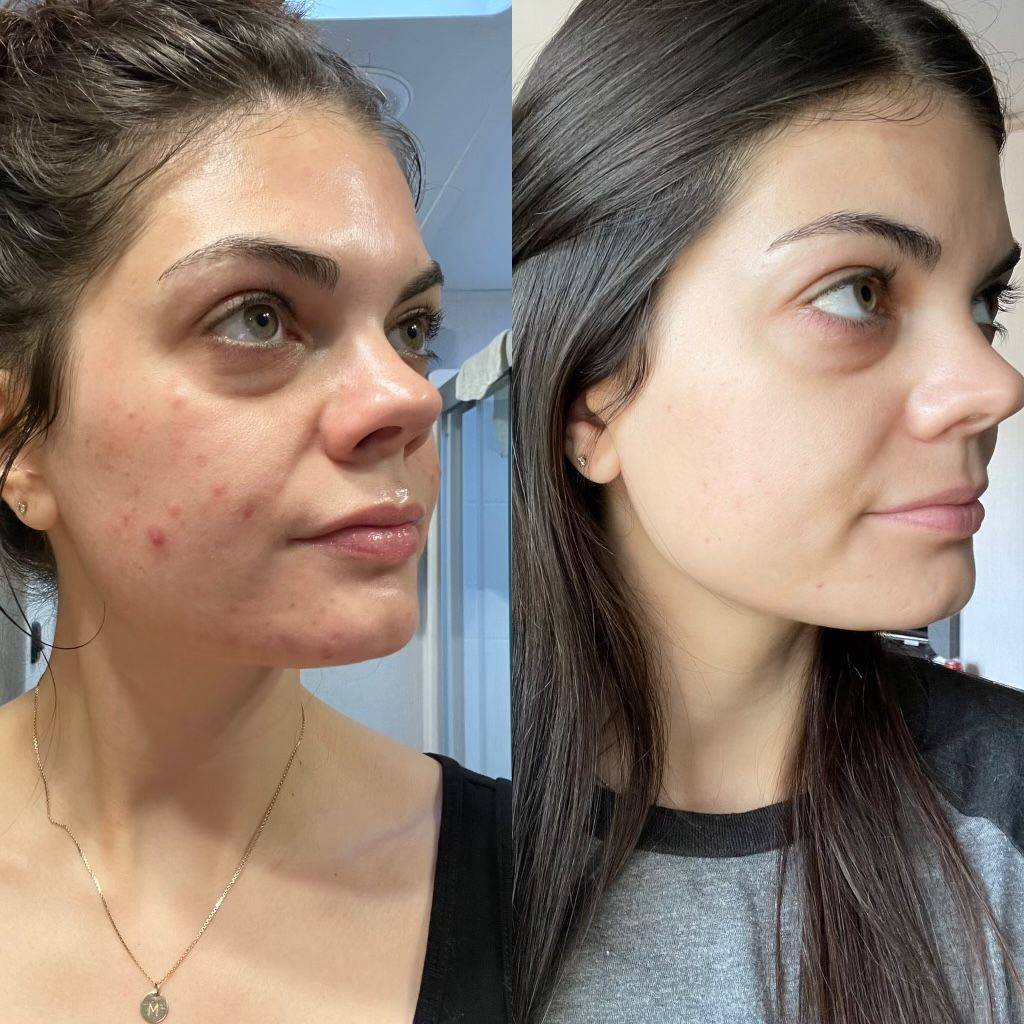 HydraFacial pore refinement treatment to minimize enlarged pores and improve skin texture Beaverton OR