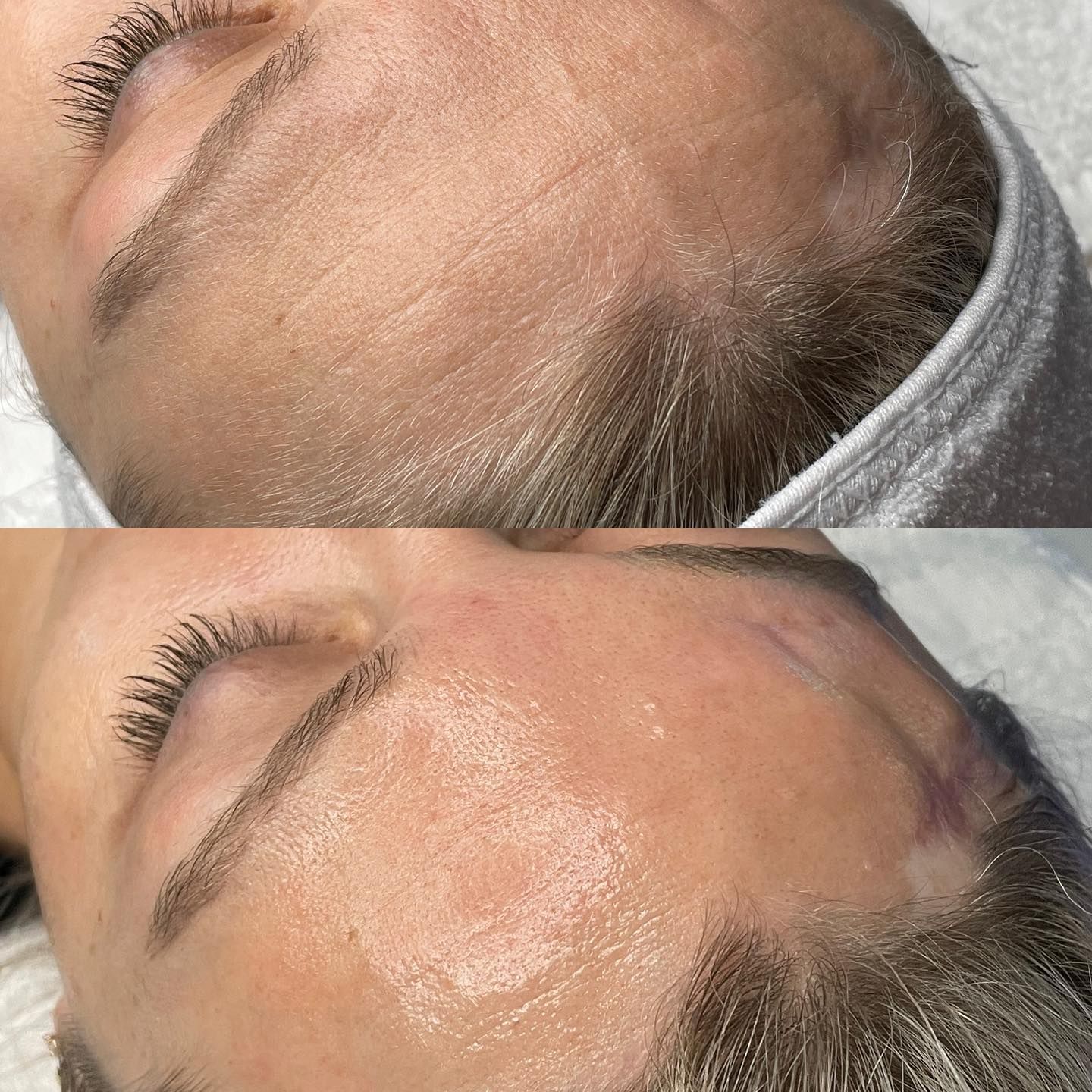Hydrafacial Hydration